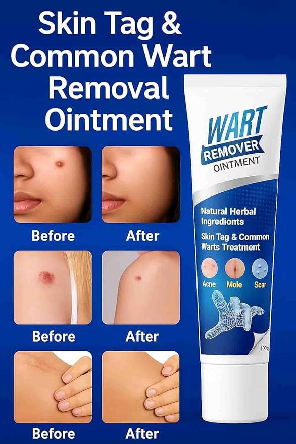 New Wart Remover Ointment PACK OF 2
